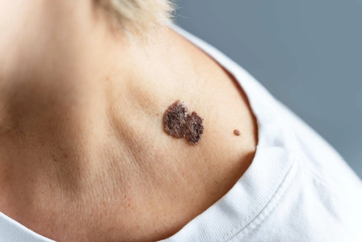 queratosis seborreica