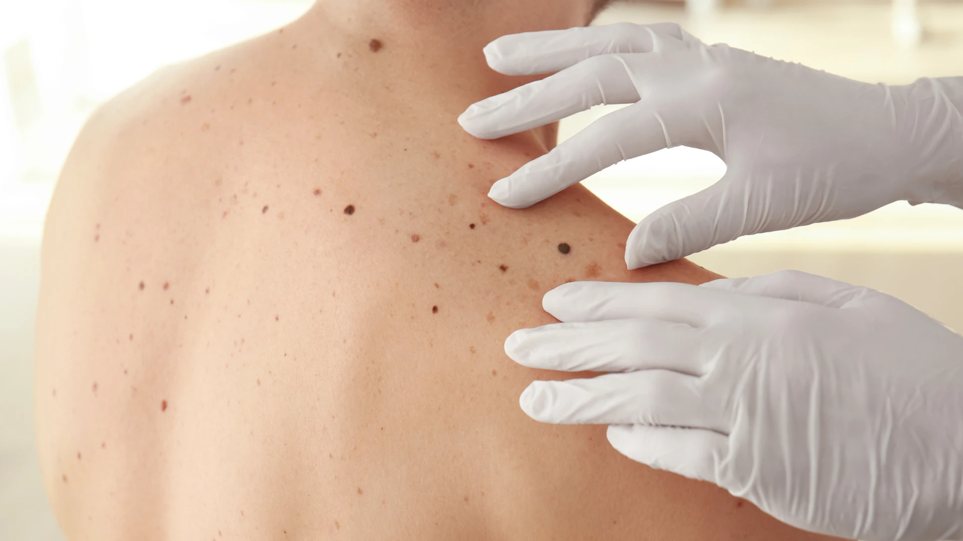 tipos de cancer de piel todo lo que debes saber