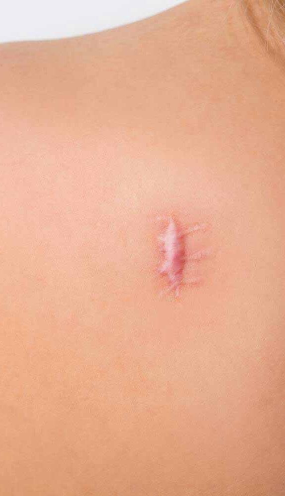 ¿cuales son los tipos de cicatrices tips para disminuir cicatrices spas en mexico