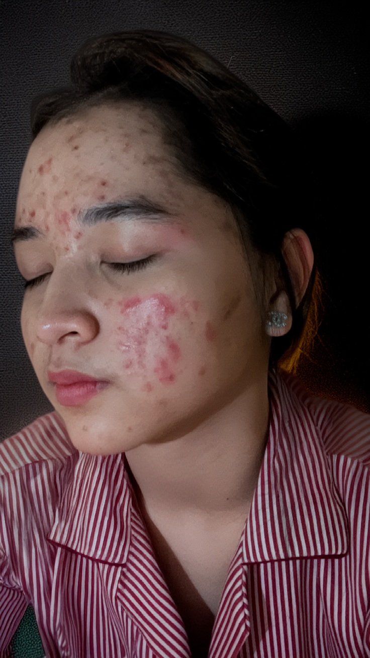 Tratamiento con Isotretinoína oral