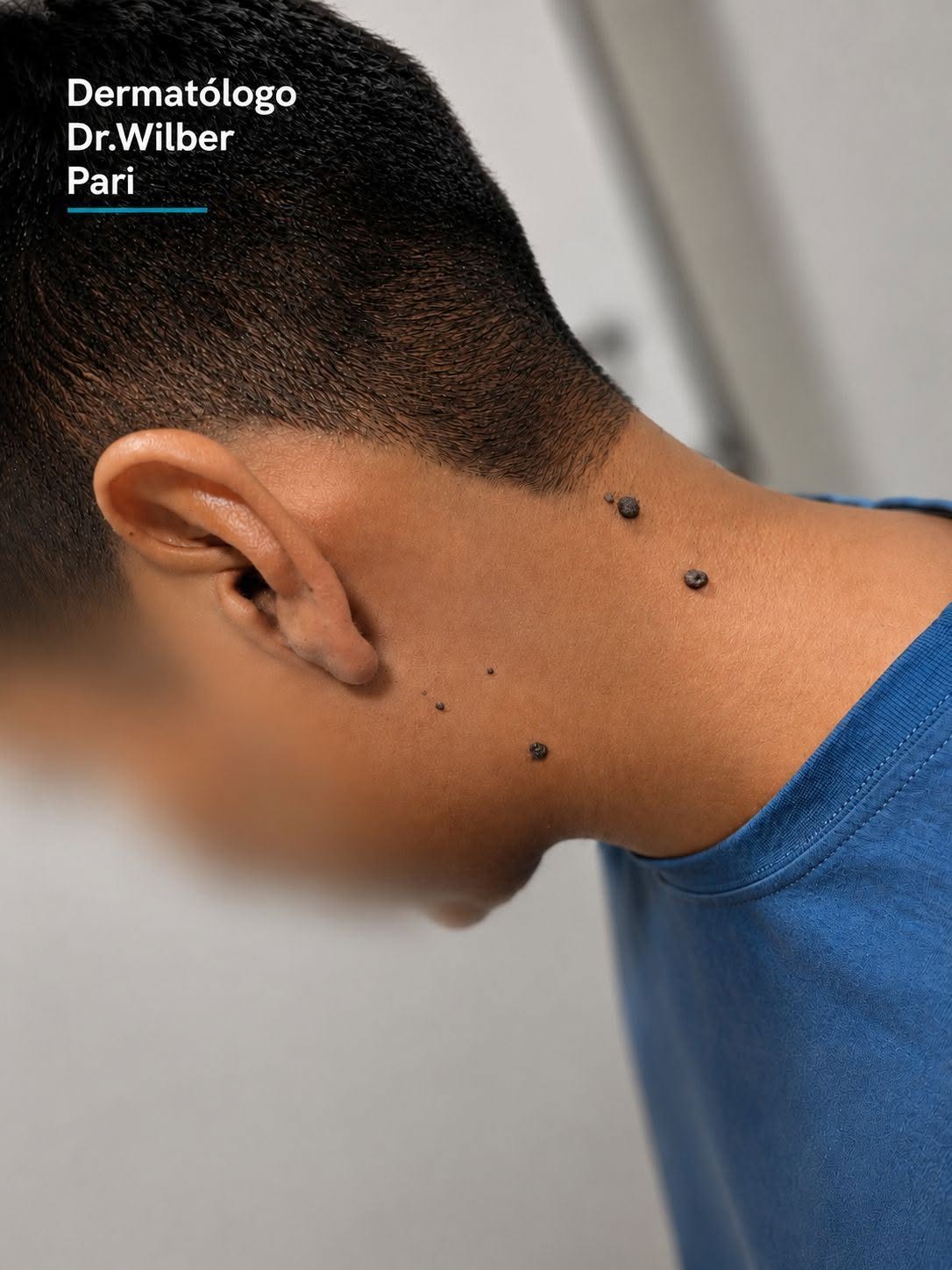 Extirpación de lunares