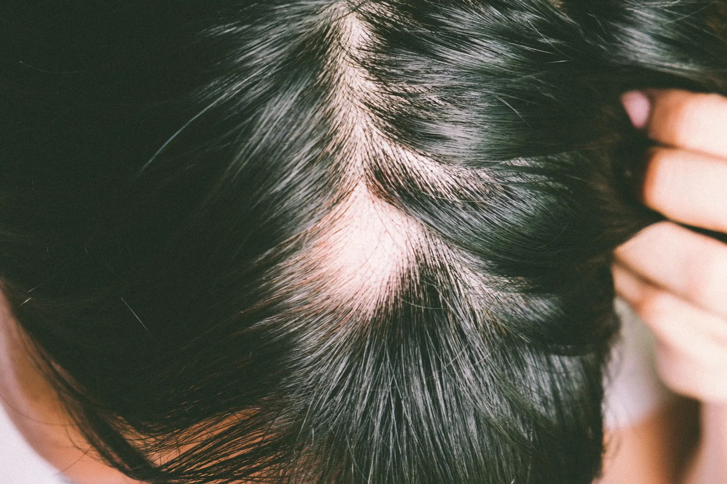 Tratamiento para la Alopecia