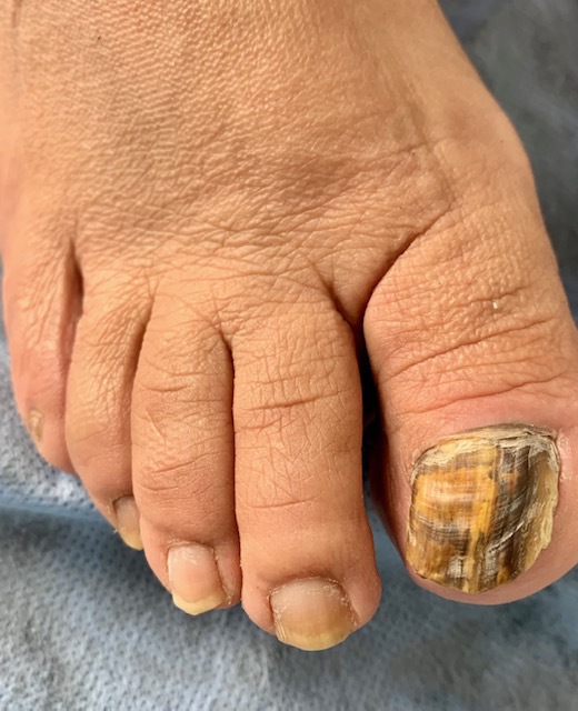 Tratamiento para Hongos (Onicomicosis)