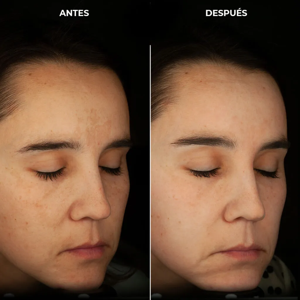 Tratamiento para manchas y melasma