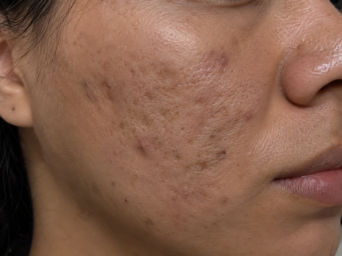 Procedimiento Quirúrgico Dermatológico