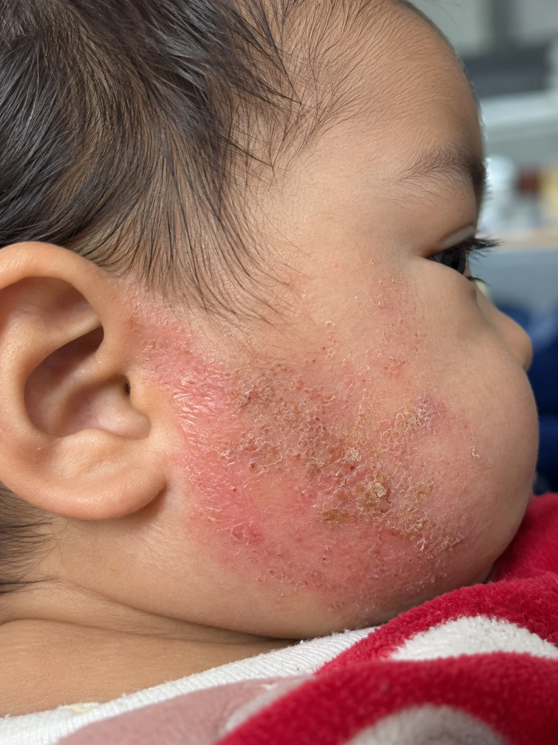 Dermatitis Atópica & Eczema Infantil