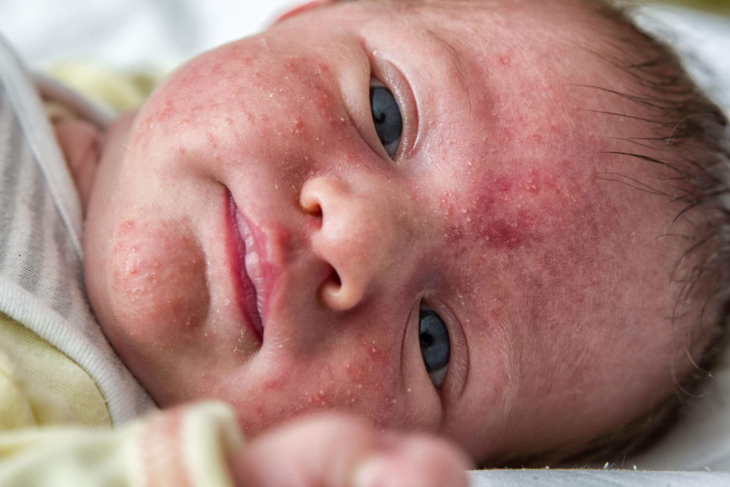 Acné Neonatal