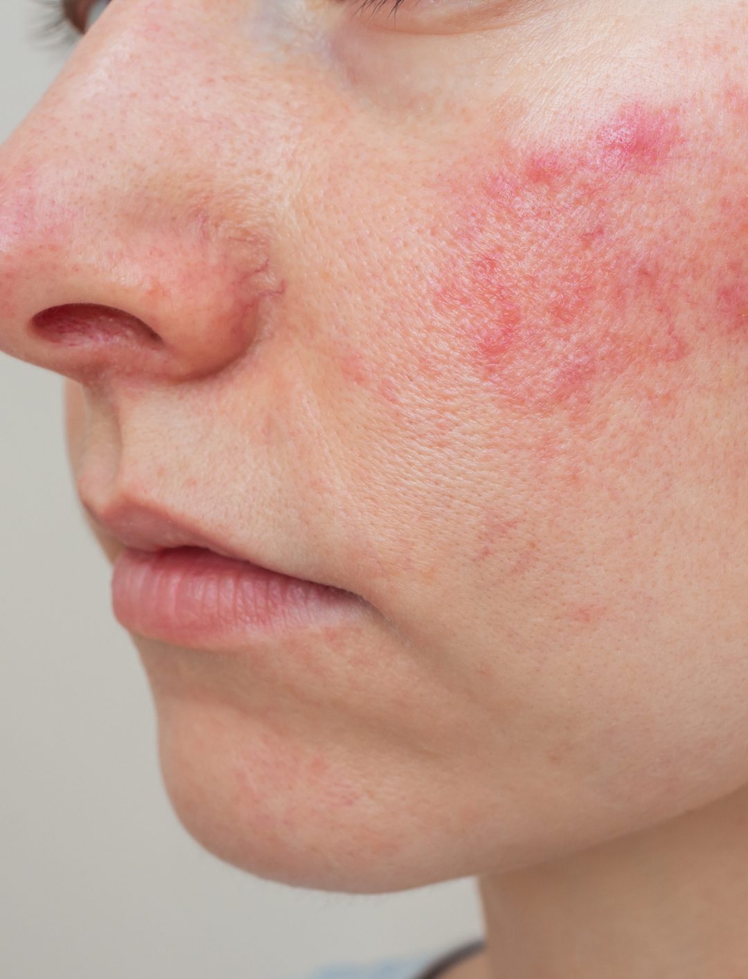 woman suffering from the skin chronic disease rosacea on her face in the acute stage.