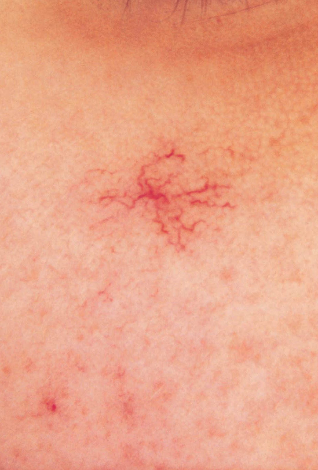 spider angiomata before